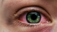 What Causes Dry Eyes and When Should You See a Doctor